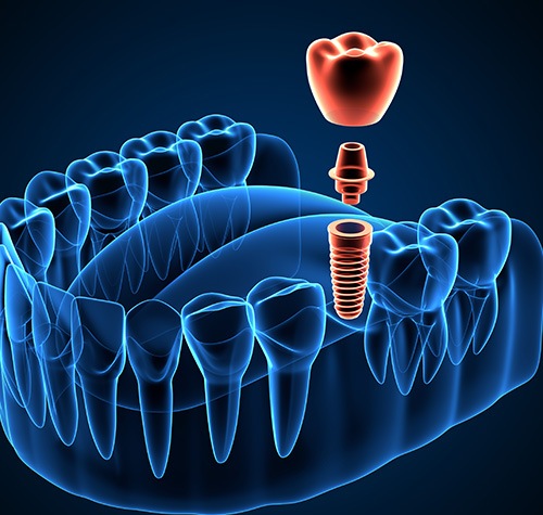 Diagram showing parts of a dental implant in Norwood