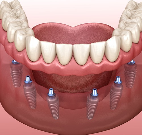 A 3D illustration of an implant denture
