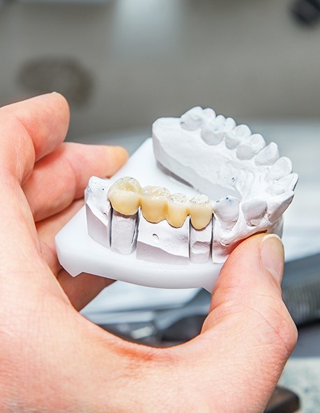 Hand holding plaster tooth model with a dental bridge