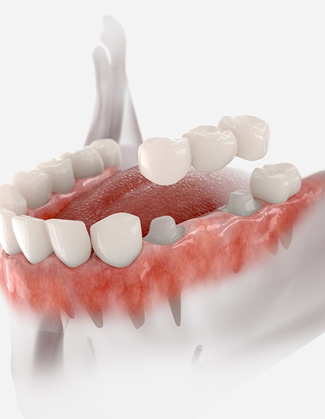 Illustration of traditional bridge being placed on teeth