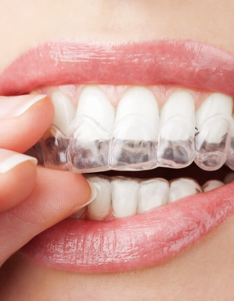 Close up of person placing a teeth whitening tray over their teeth