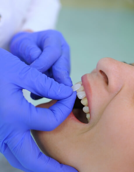 Dentist placing a veneer over a tooth