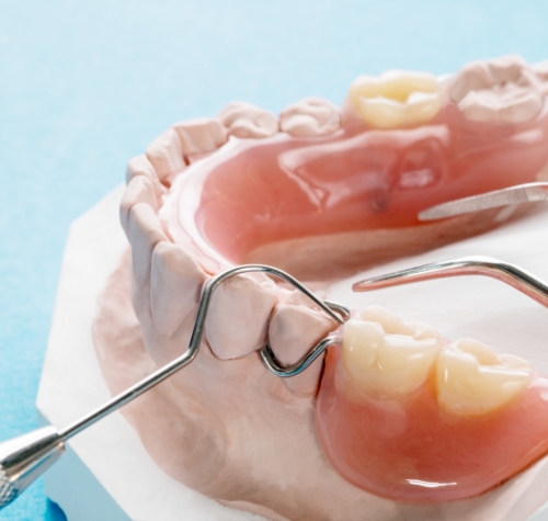Partial denture replacing several missing teeth in a model of the lower teeth
