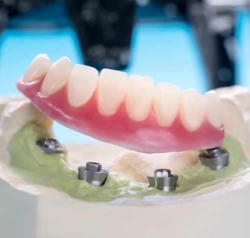 Denture over a model of the lower teeth with four dental implants