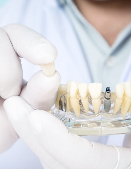 Dentist holding a dental crown and a model of the mouth with a dental implant