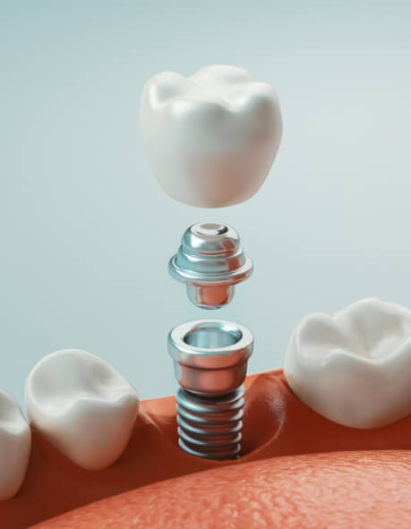 Illustrated dental implant with crown being placed in lower arch