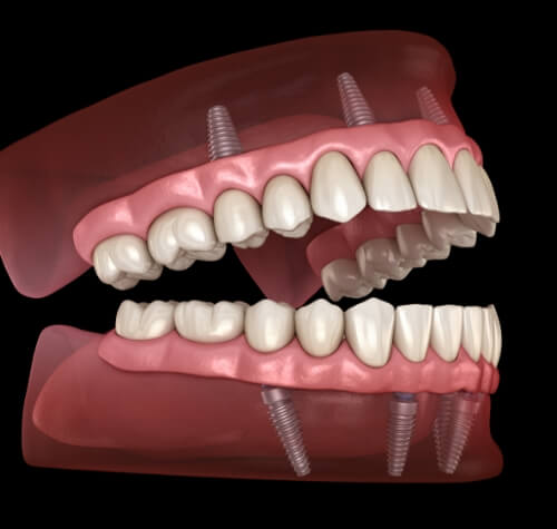 Illustrated implant dentures on both arches
