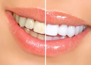 Closeup of woman's smile with sparkly gloss that's half whitened