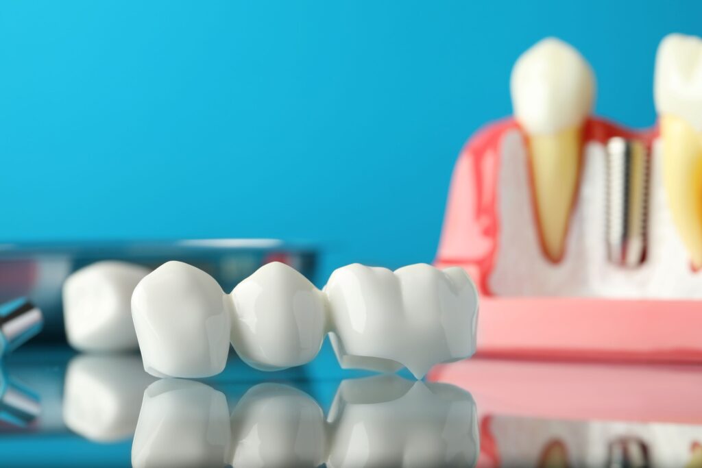 Dental bridge in front of sample dental implant with blue background